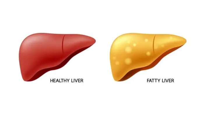 Can Fatty Liver Be Reversed? Dr Wendi LeBrett Shares 4 Key Lifestyle Changes