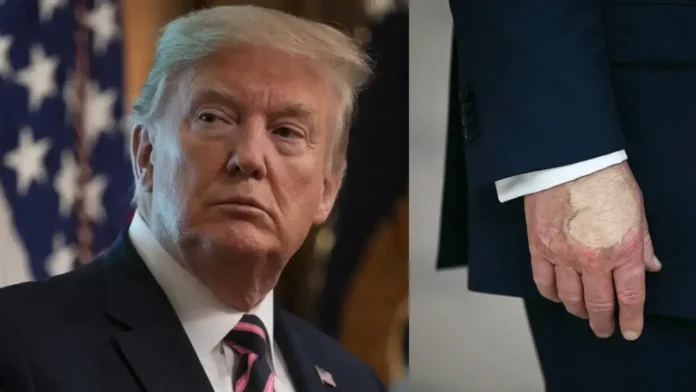 Concerns Raised Over Donald Trump's Health After Makeup Spotted on His Hand