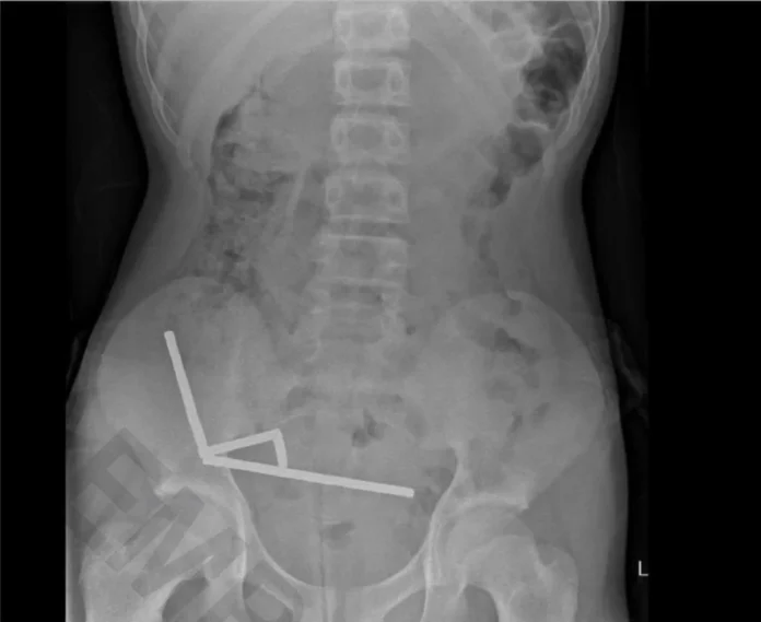 New Zealand Boy Undergoes Emergency Surgery After Swallowing Nearly 100 Powerful Magnets