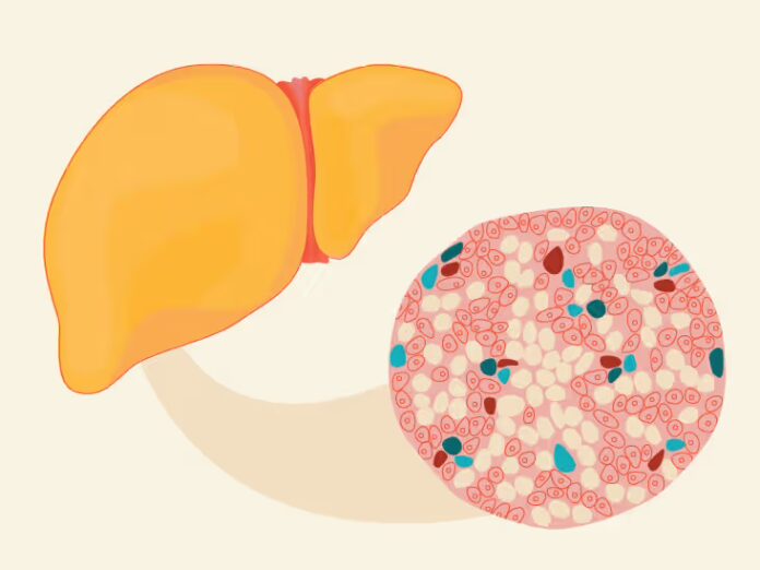 Grade 2 Fatty Liver: Causes, Risks And Can It Be Reversed? Experts Explain