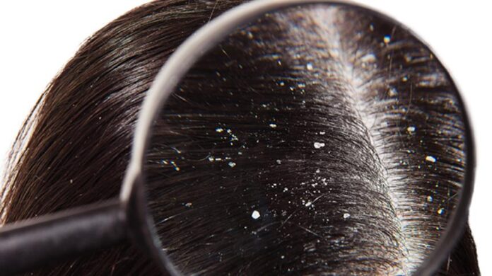 Flake Check: Is It Dandruff or Just a Dry Scalp?