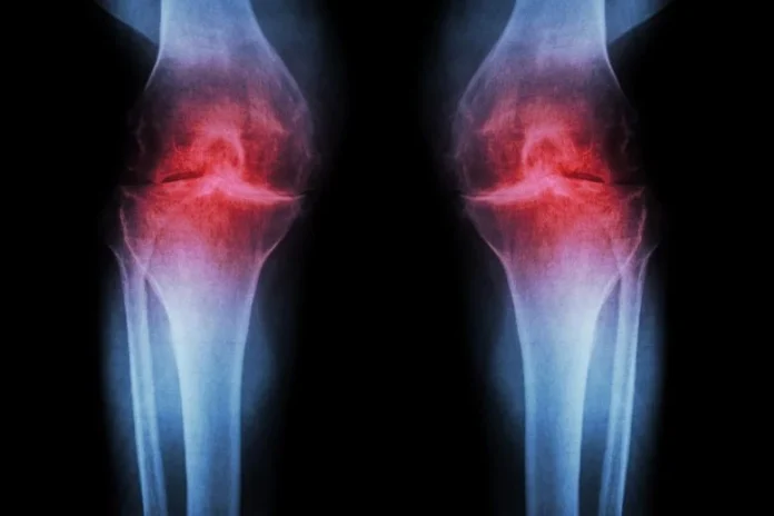 Stanford Scientists Discover Protein Target That Could Reverse Cartilage Damage In Osteoarthritis