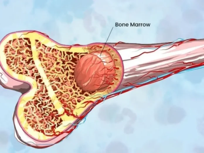 Bone Marrow: Why Fatigue And Recurrent Infections Should Not Be Ignored?
