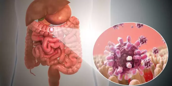 Stomach Cancer Symptoms: 7 Early Warning Signs Of Gastric Cancer You Shouldn’t Ignore
