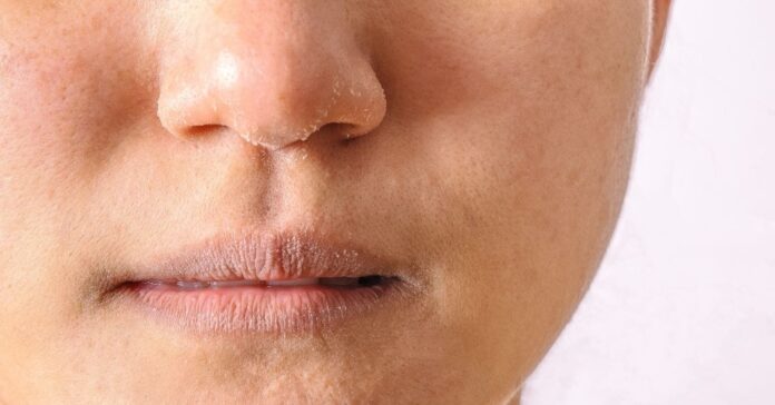 Dry Skin Around Nose? Causes, Symptoms And Expert Tips To Treat Flaky, Irritated Skin